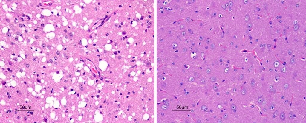 Two brain histology sections side by side: one shows spongiform vacuolation, many empty round spaces in the neuropil, the other shows normal-looking brain tissue for comparison