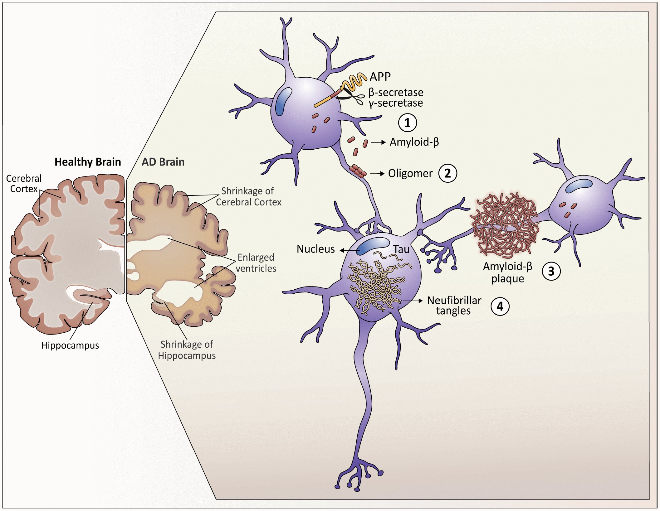 Alzheimer's pathway: healthy versus AD brain shows cortical shrinkage and enlarged ventricles; a neuron cleaves APP by beta- and gamma-secretase into amyloid-beta, which forms oligomers and a plaque, while intracellular Tau forms neurofibrillary tangles