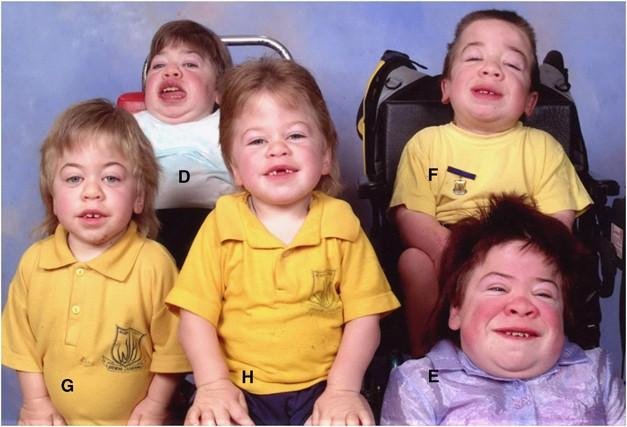 Photograph of several children with I-cell disease, mucolipidosis II, showing coarse facial features, short stature and restricted mobility, one seated in a wheelchair