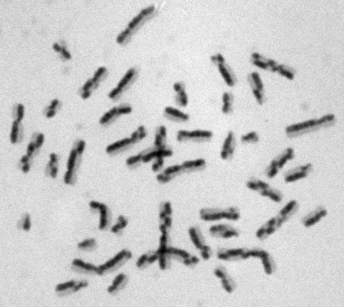 Metaphase chromosome spread with numerous crossover figures between sister chromatids, the microscopic sign used to recognise Bloom syndrome