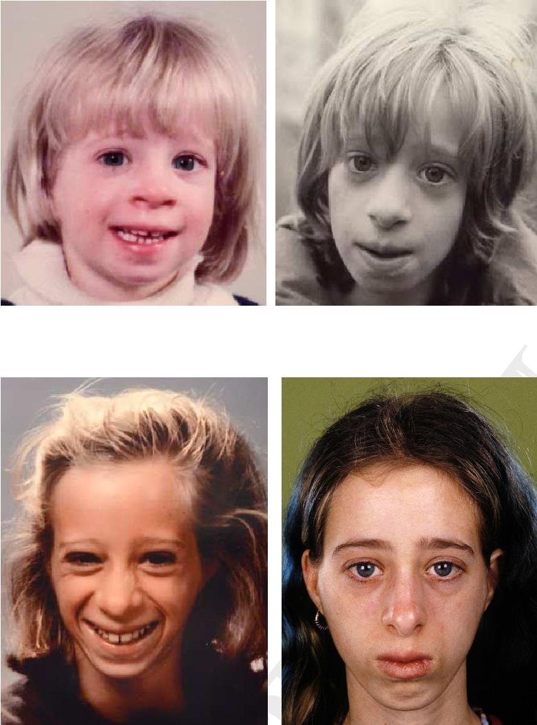 Facial photographs of children with Bloom syndrome, showing the characteristic narrow face, prominent nose and sun-sensitive skin marks