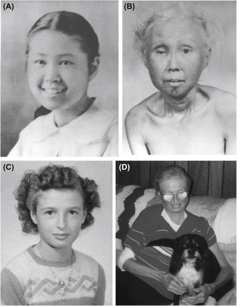 Paired photographs of the same Werner syndrome patients young and decades later, showing the greying hair, skin atrophy and aged appearance that develops far earlier than normal