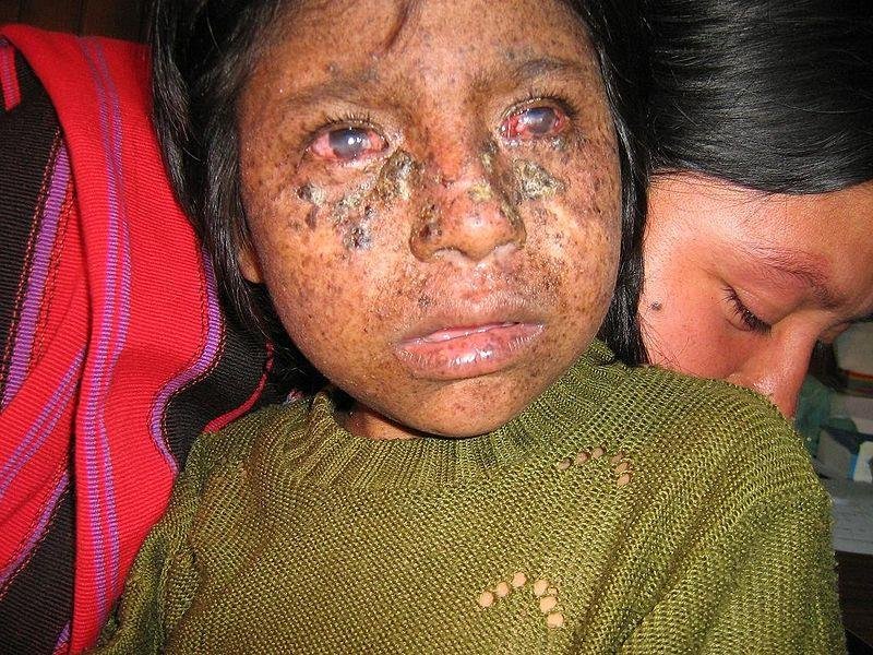 A child with xeroderma pigmentosum showing severe UV-induced facial skin lesions, pigmentation and eye damage from ordinary daylight exposure