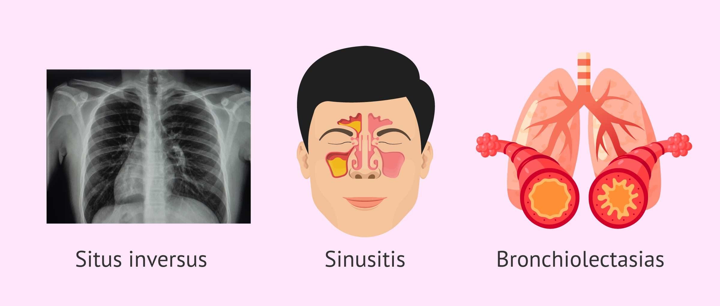 The Kartagener syndrome triad: situs inversus on a chest X-ray, sinusitis, and bronchiectasis of the lungs
