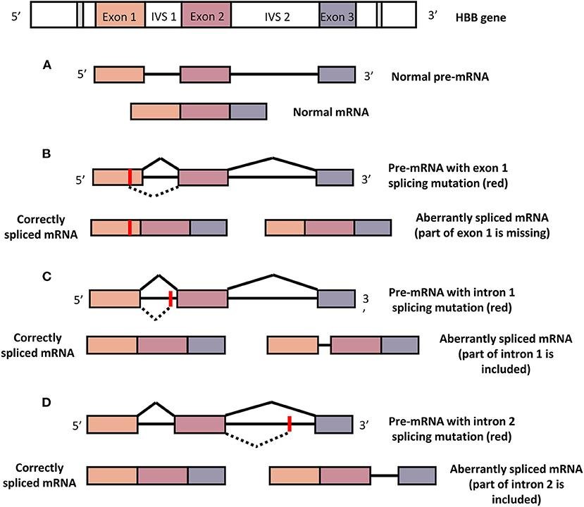 HBB gene with exon 1, IVS1, exon 2, IVS2, exon 3: normal splicing gives the correct mRNA (A), while a splicing mutation in exon 1 (B), intron 1 (C) or intron 2 (D) each produces an aberrantly spliced mRNA missing or retaining part of that region